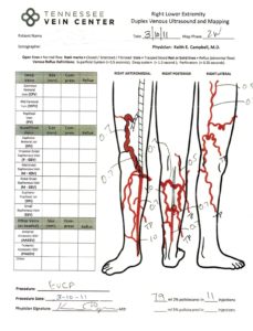 Varicose Veins Knoxville TN