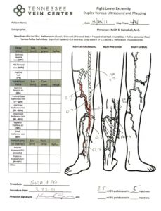 Varicose Veins Maryville TN