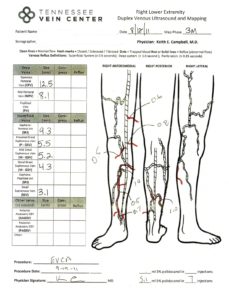 Varicose Veins Treatment Knoxville TN