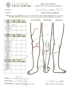 Varicose Veins Treatment Maryville TN