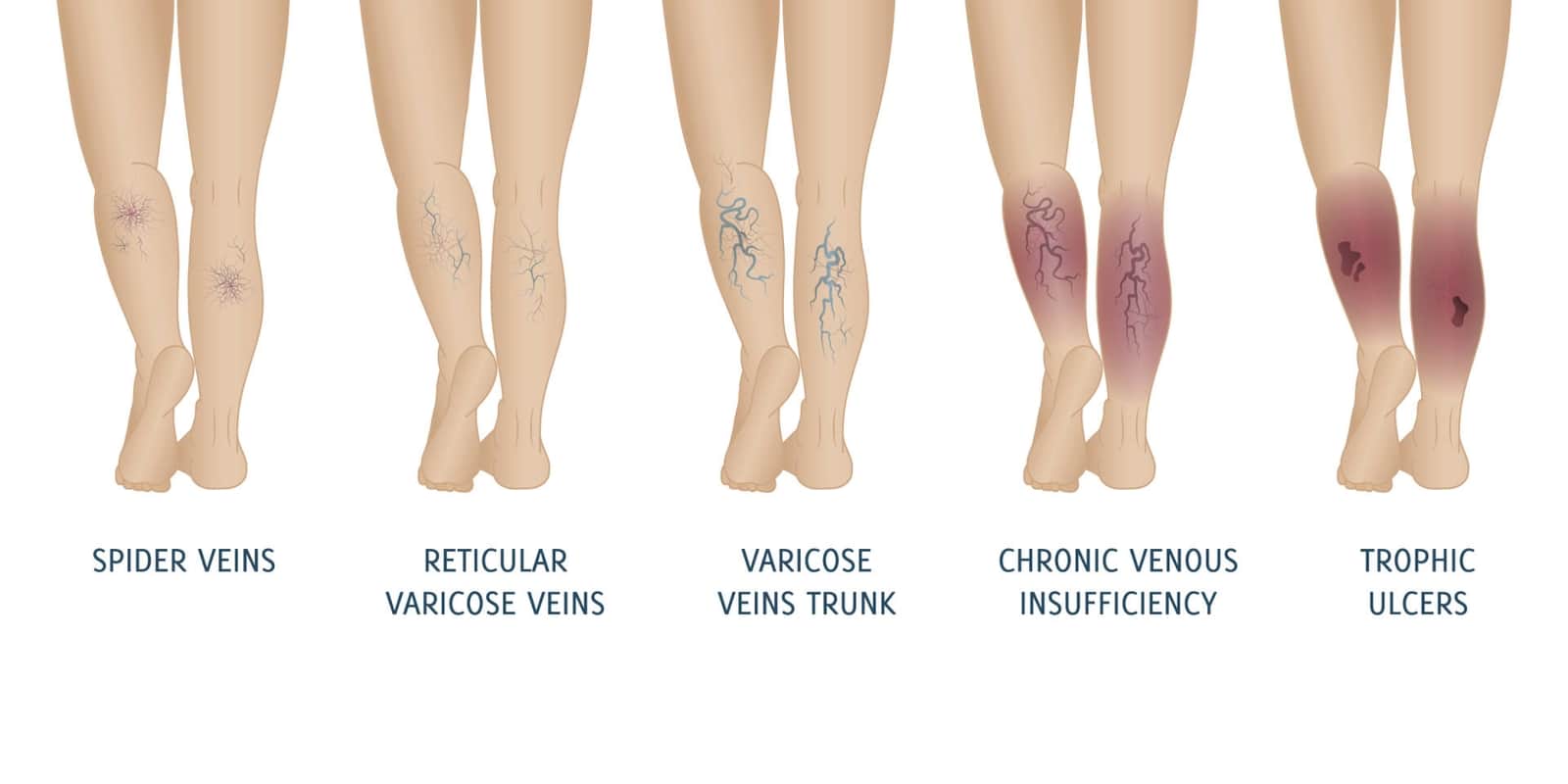 Veins Treatment Maryville TN