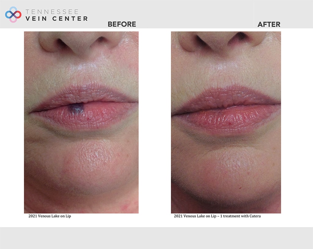 Before & After Image of Venous Lake Treatment Maryville TN