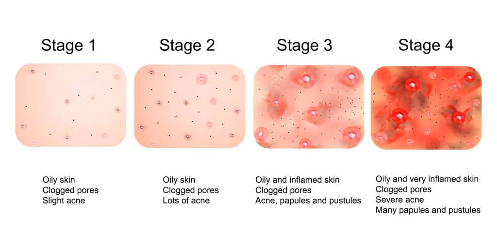 Acne/Breakout Prone Skin Treatment in Alcoa, TN