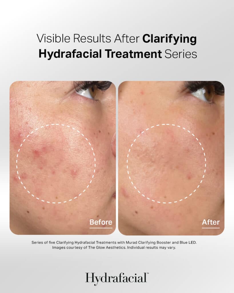 Hydrafacial in Knoxville, TN