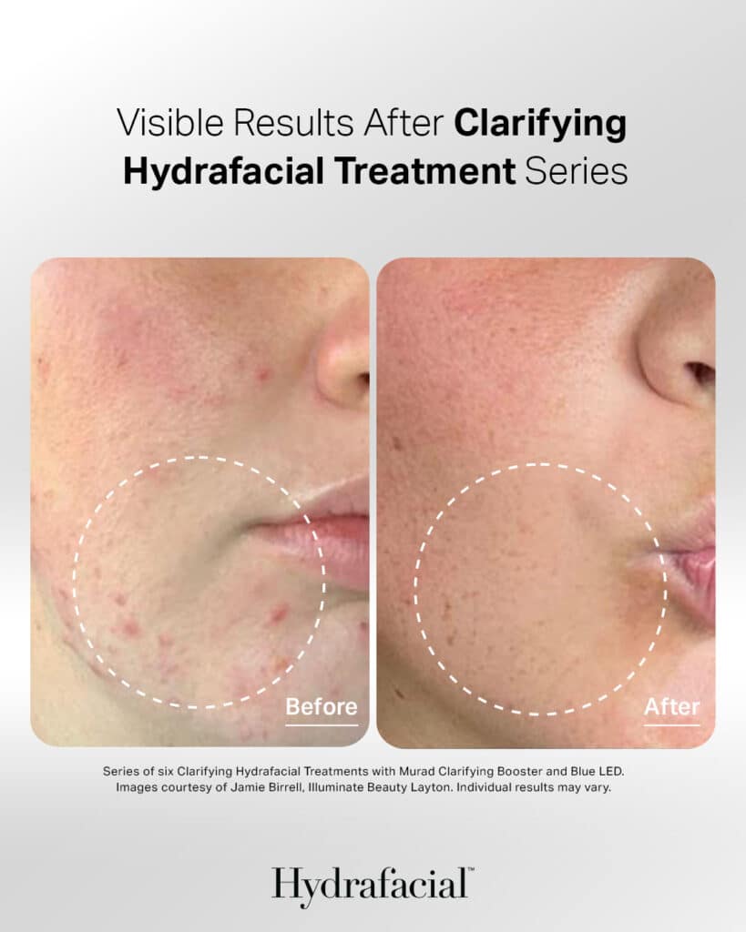 Hydrafacial in Knoxville, TN