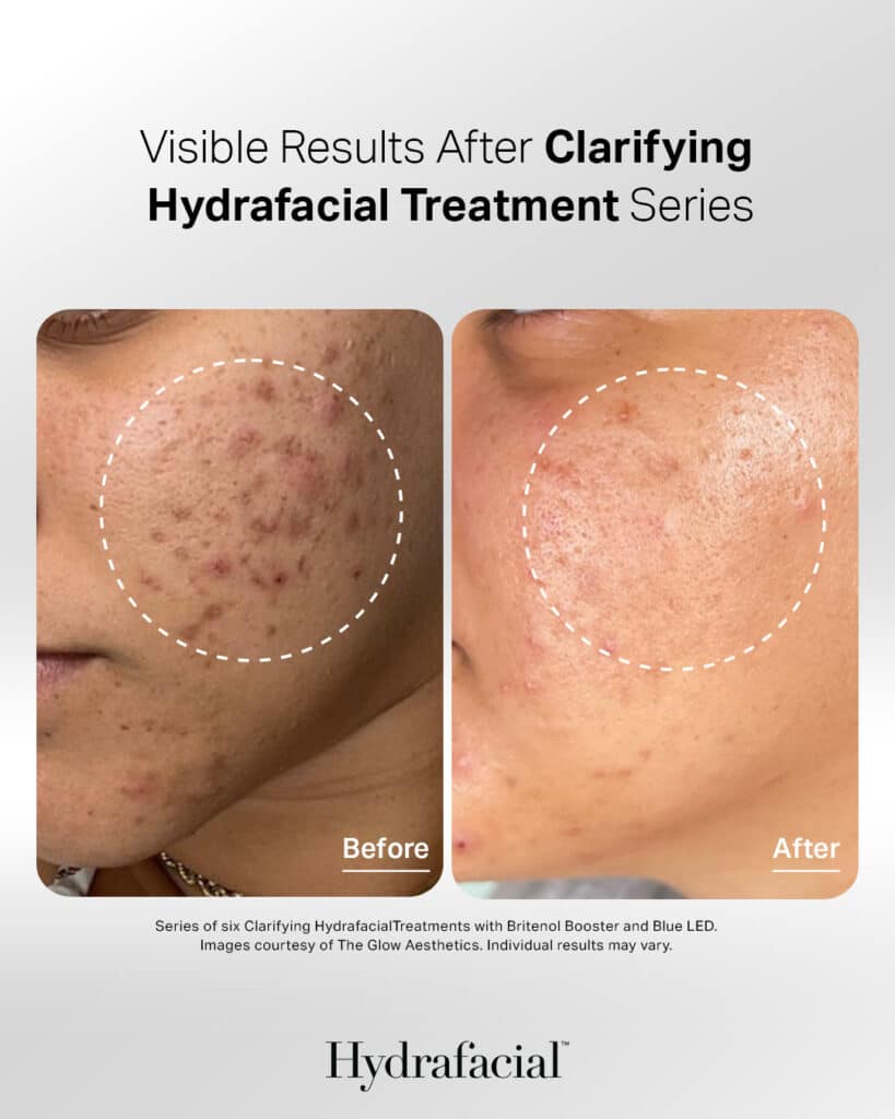 Hydrafacial in Knoxville, TN