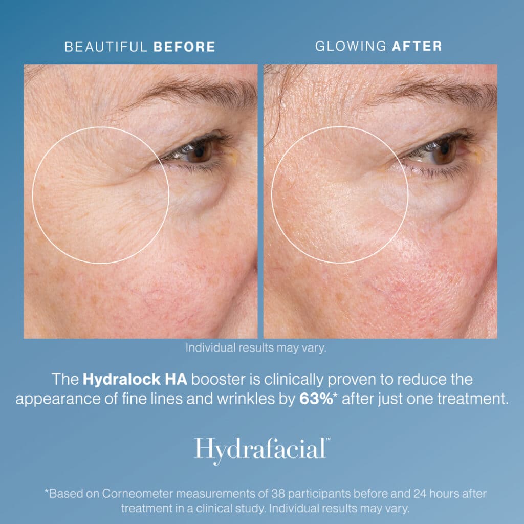 Hydrafacial in Knoxville, TN