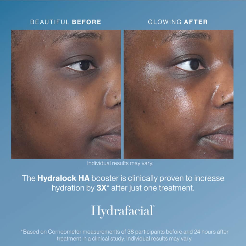 Hydrafacial in Knoxville, TN