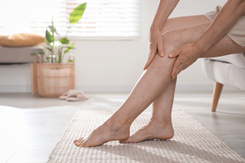 Close up of a patient's legs with dark varicose veins on the back of the knees, in need of treatment.
